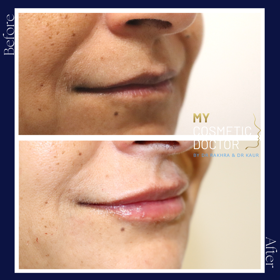 A before and after photo of a woman 's lips by my cosmetic doctor