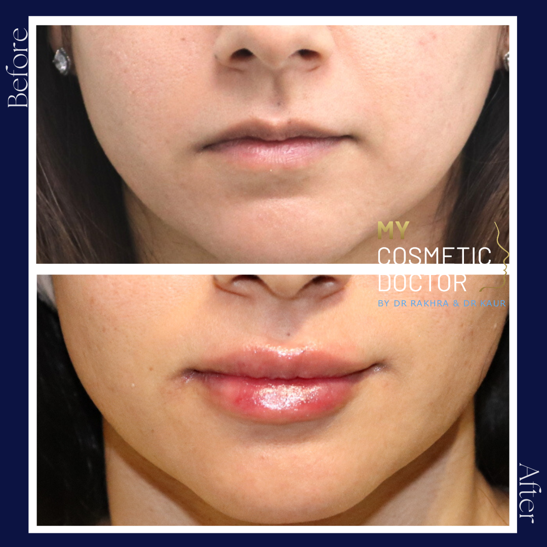 A before and after photo of a woman 's face by my cosmetic doctor