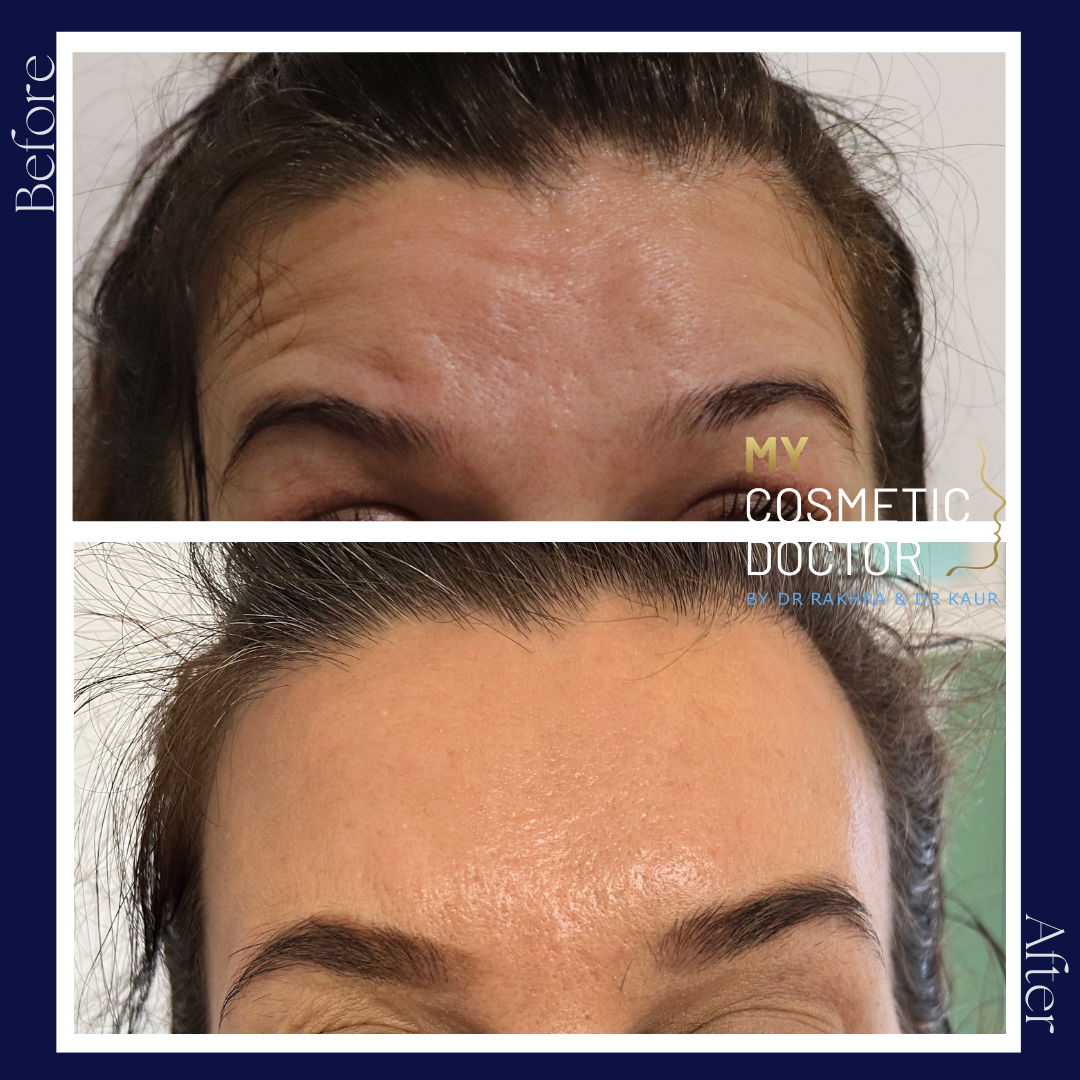 A before and after photo of a woman 's forehead