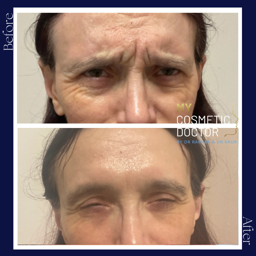 A before and after photo of a woman 's forehead with wrinkles.