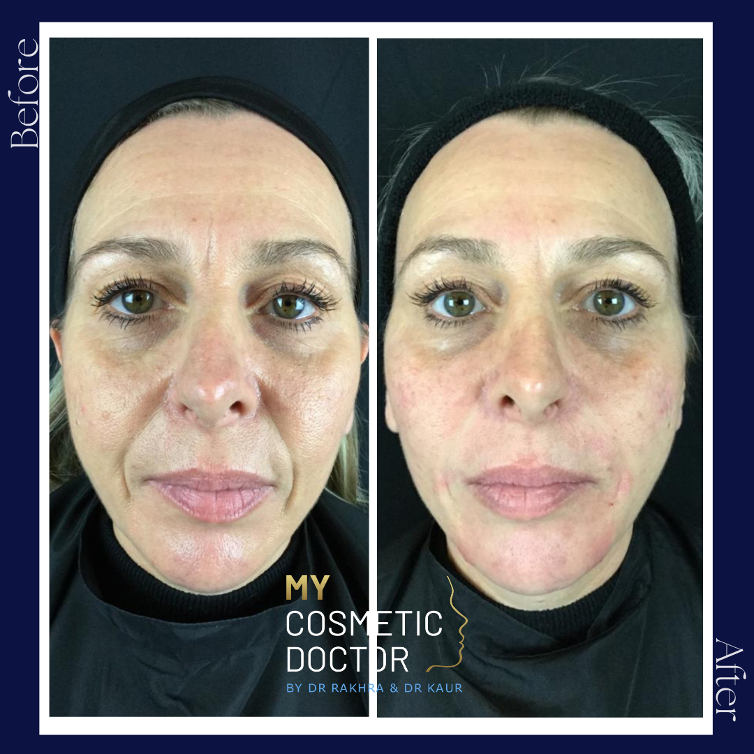 A before and after photo of a woman 's face by my cosmetic doctor
