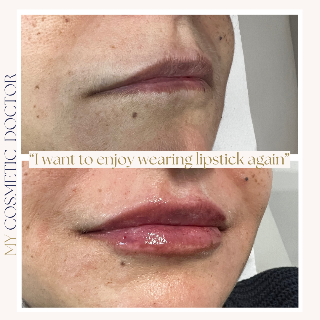 A before and after photo of a woman 's lips with the caption 