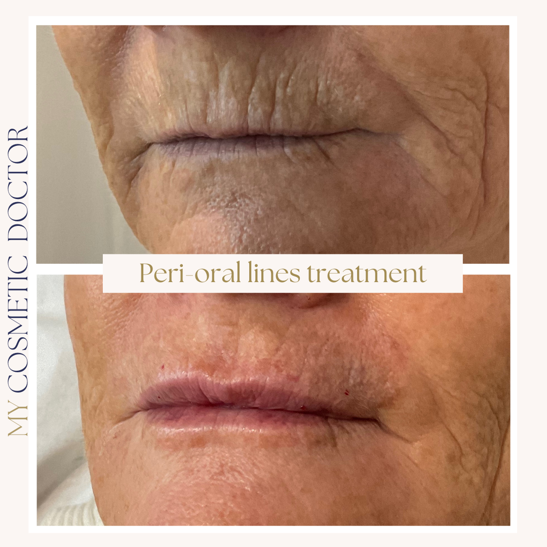 thin lips and peri oral lines