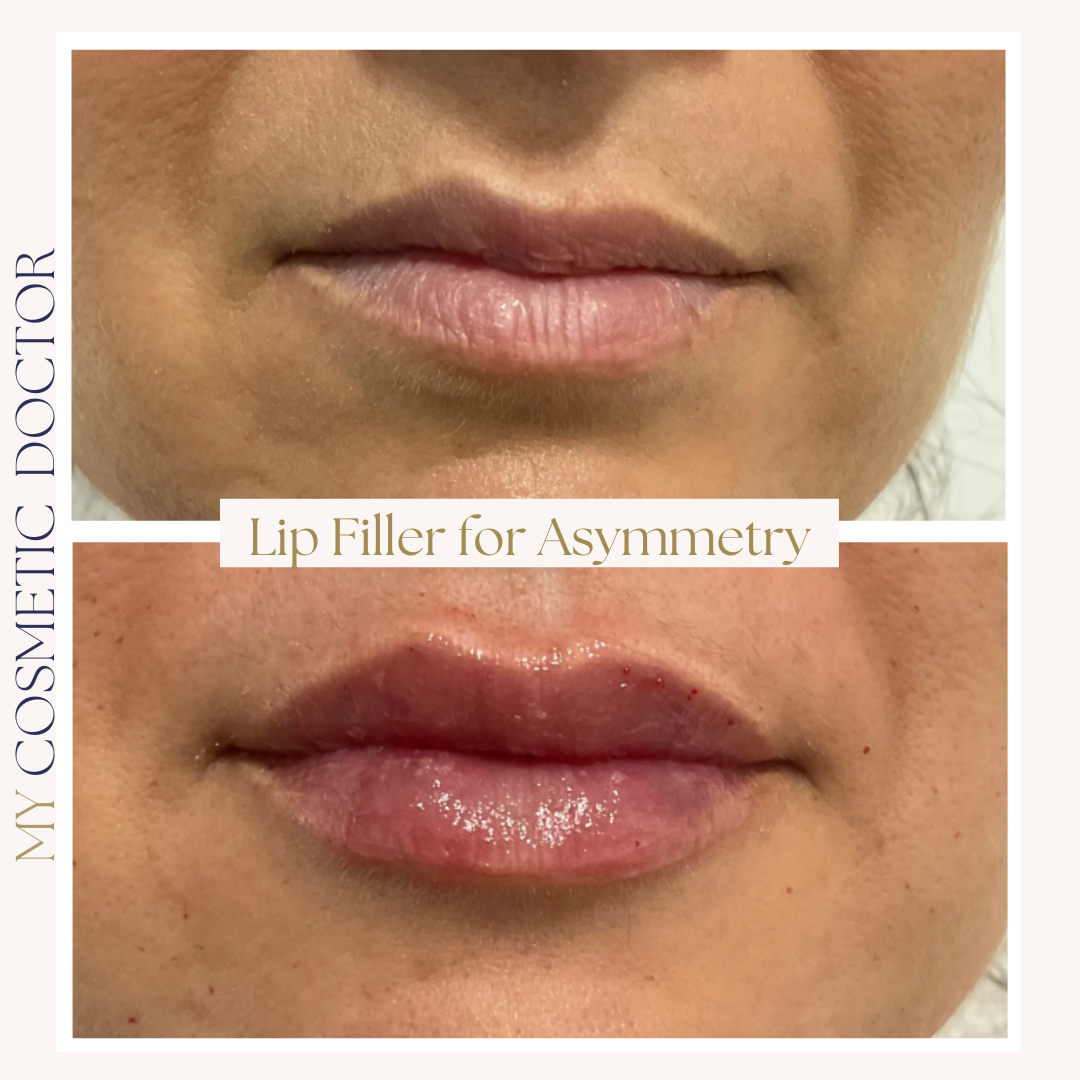 A before and after photo of a woman 's lips with the caption lip filler for asymmetry