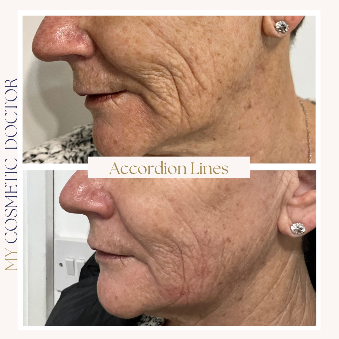 A before and after photo of a woman 's face with accordion lines.