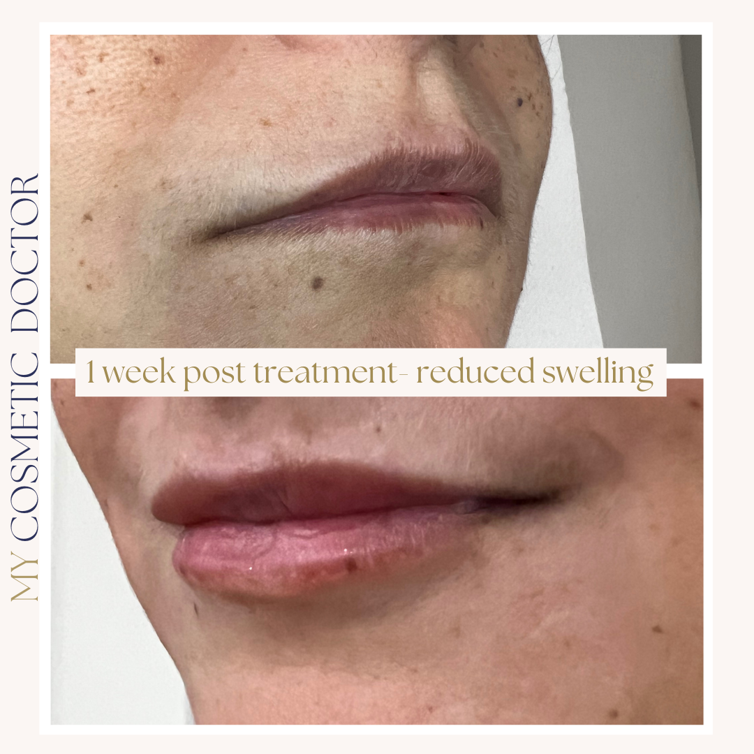 A before and after photo of a woman 's lips with the caption i week post treatment reduced swelling.