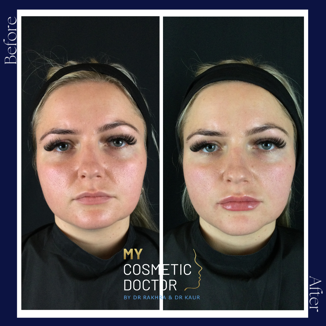 A before and after photo of a woman 's face by my cosmetic doctor