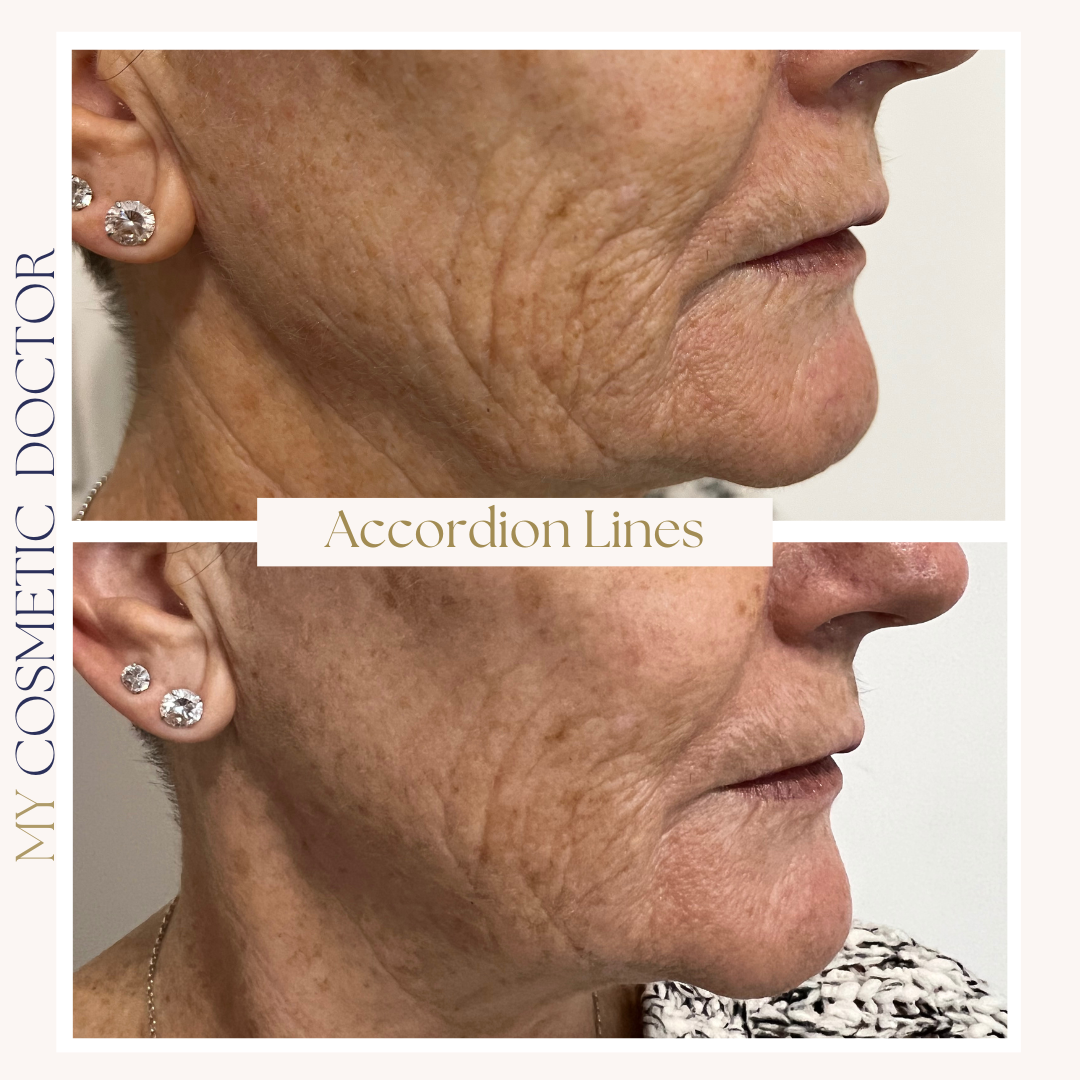 A before and after photo of a woman 's face with accordion lines
