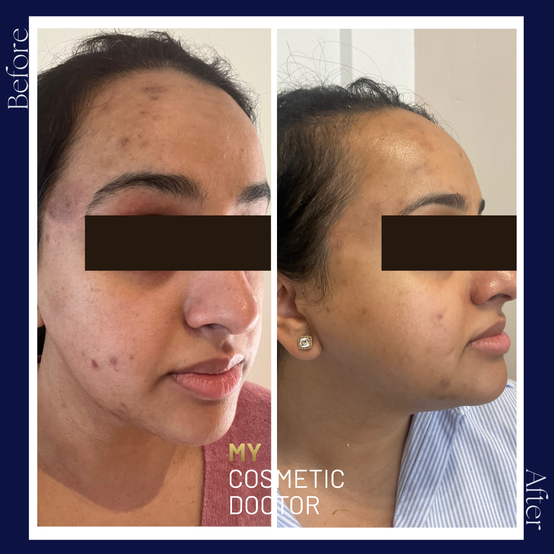 A before and after photo of a woman 's face
