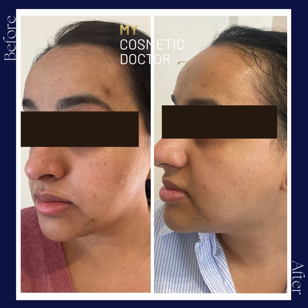 A before and after photo of a woman 's face
