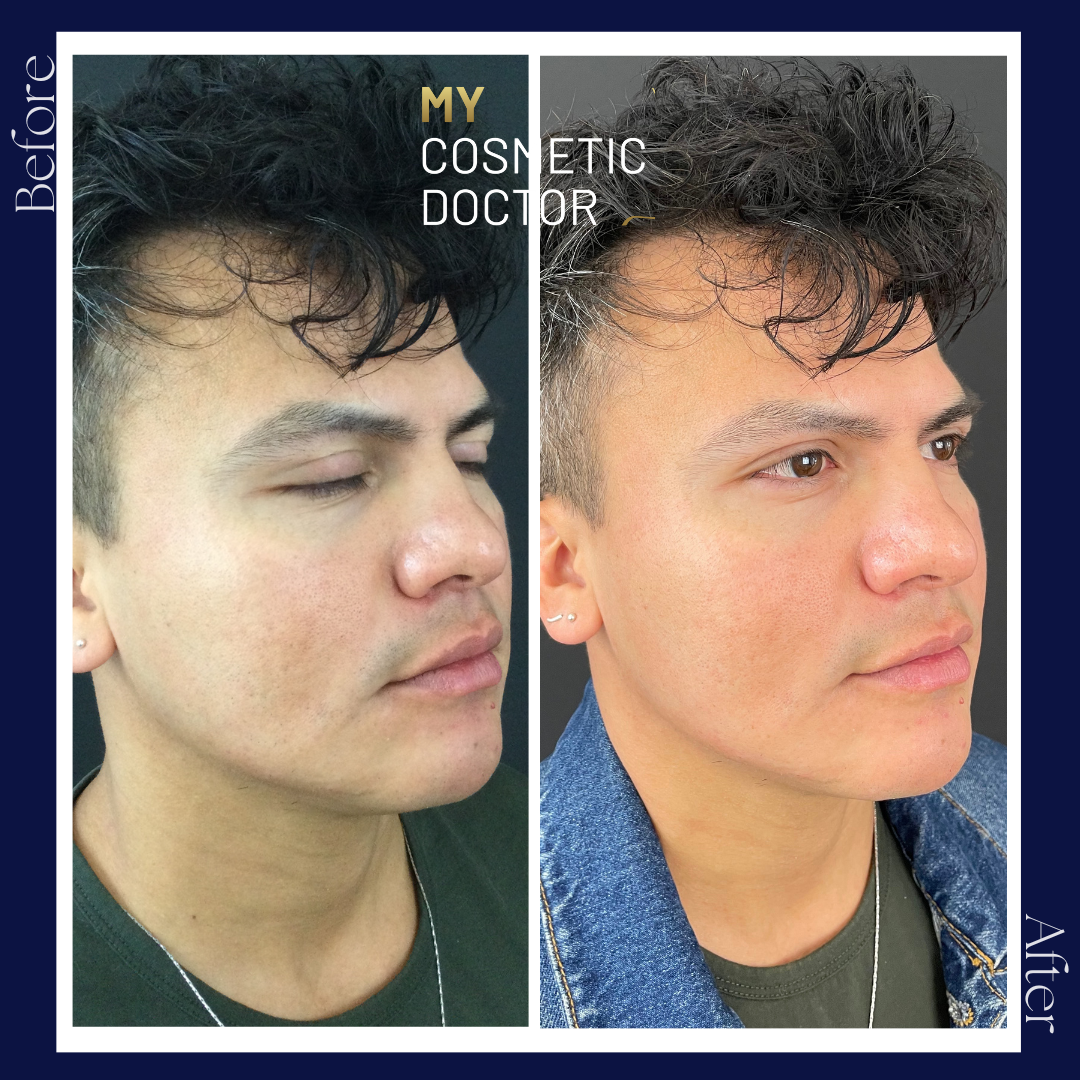 A before and after photo of a man 's face by my cosmetic doctor
