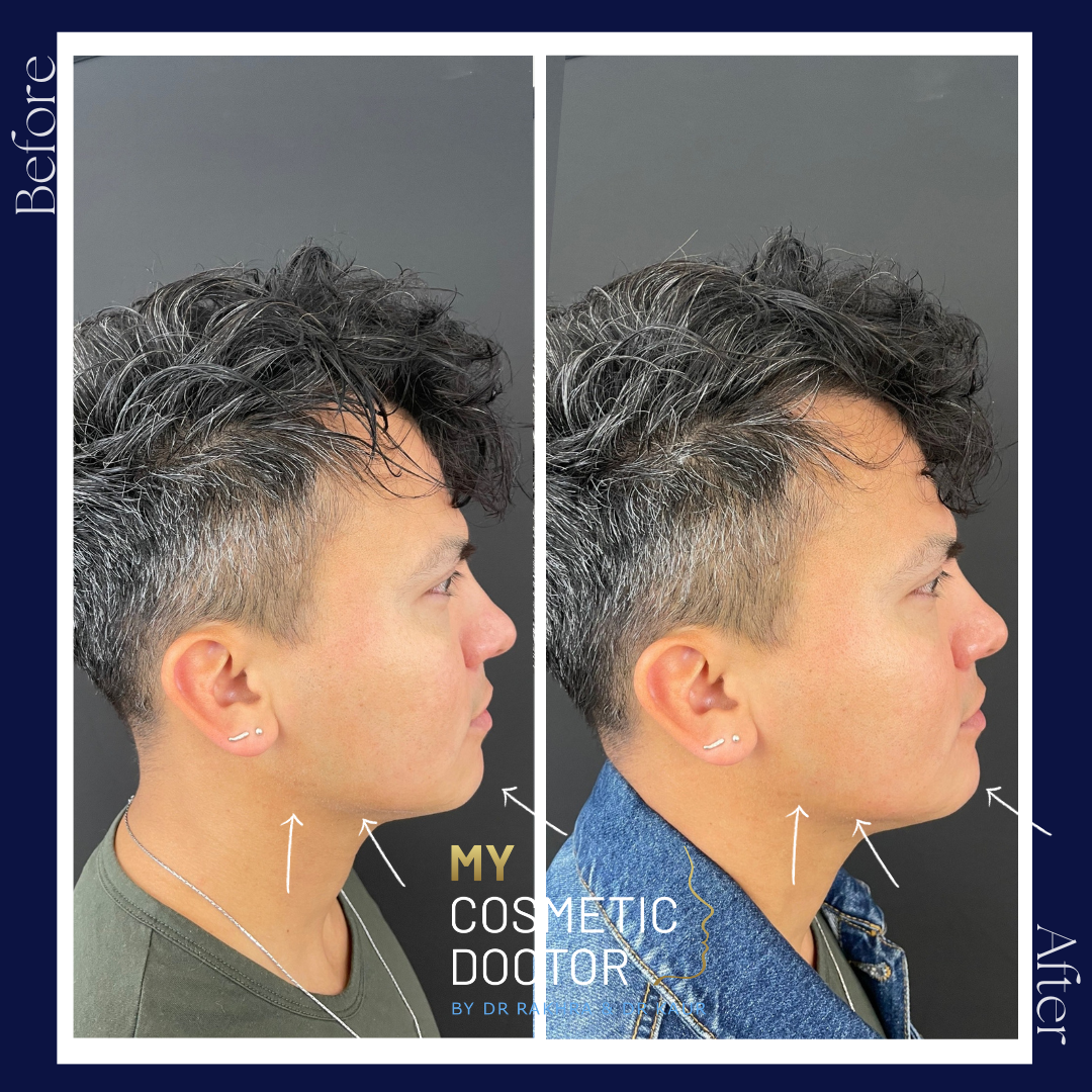 A before and after photo of a man 's face