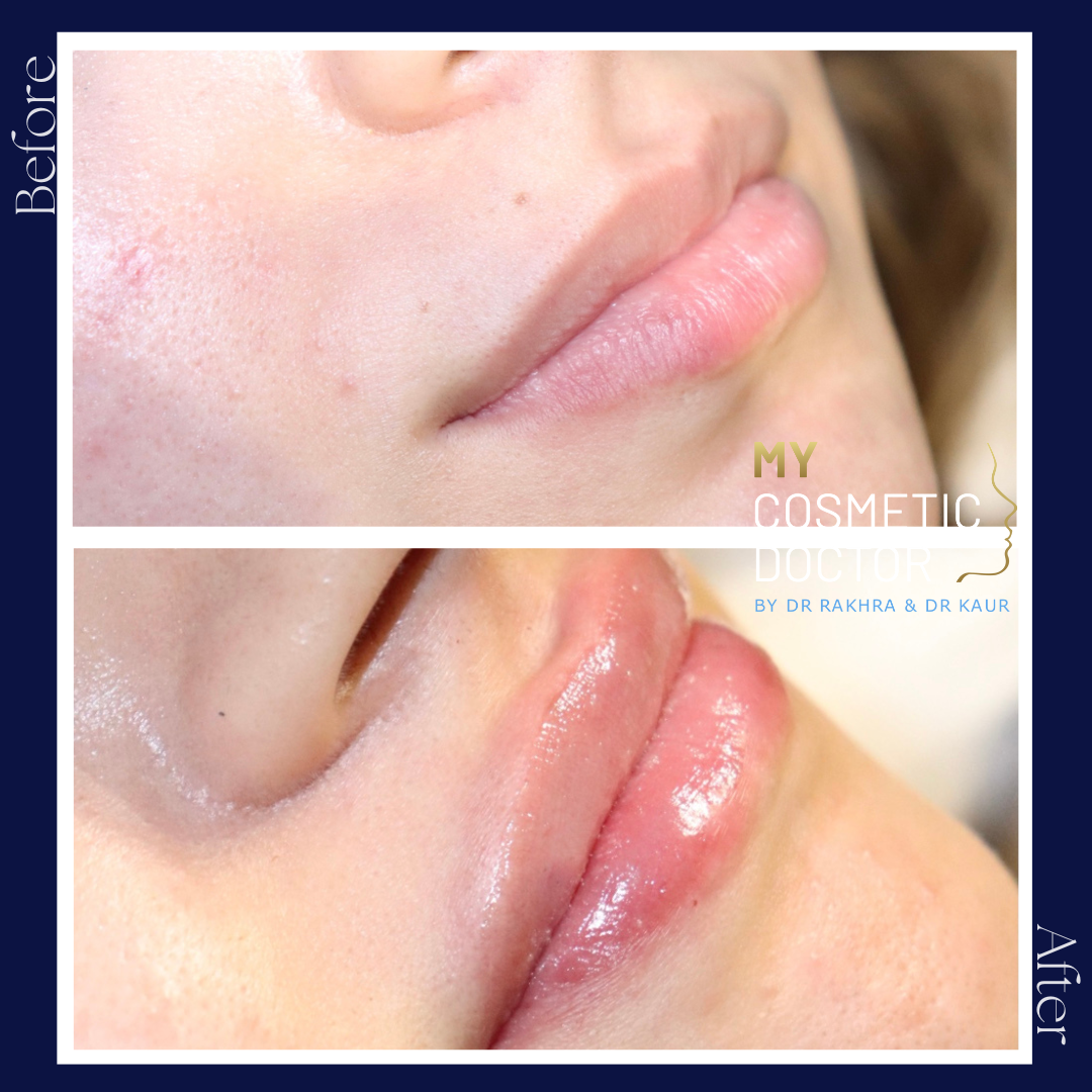 A before and after photo of a woman 's lips with my cosmetic studio written on the bottom