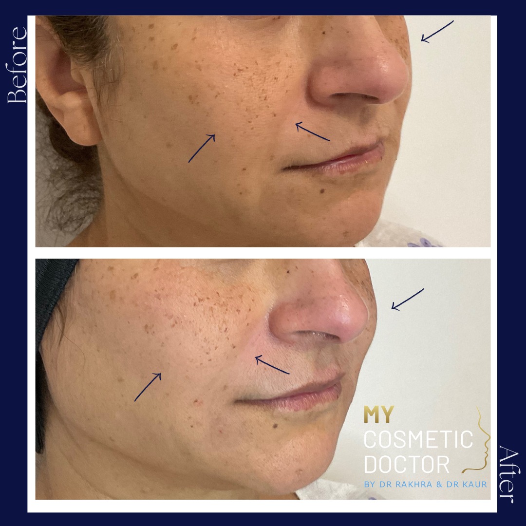 A before and after photo of a woman 's face by my cosmetic doctor