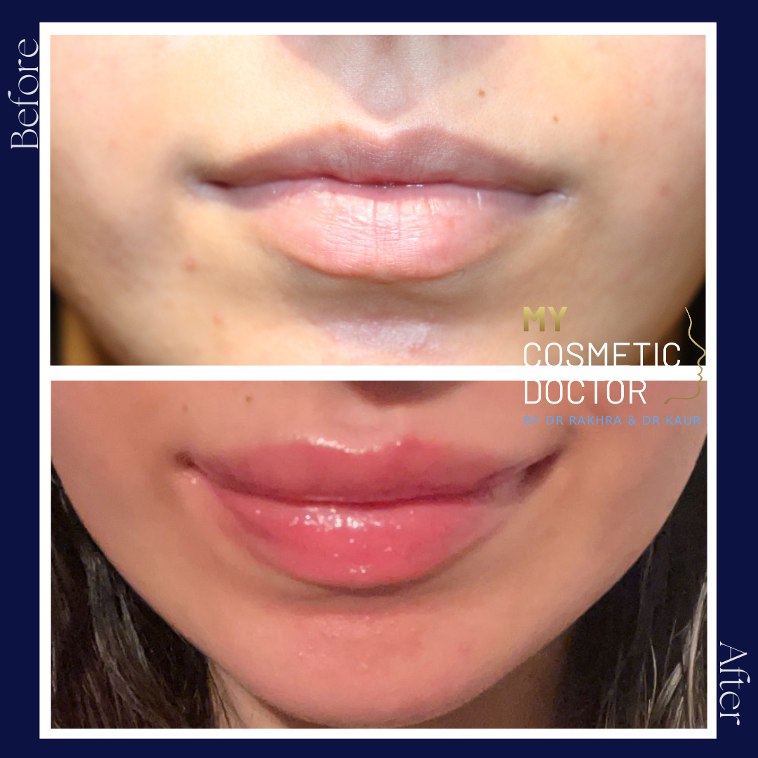 A before and after photo of a woman 's lips by my cosmetic doctor