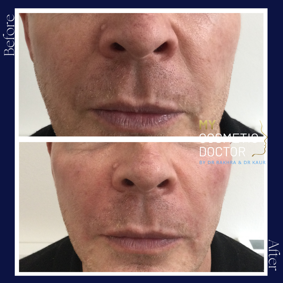 A before and after photo of a man 's face