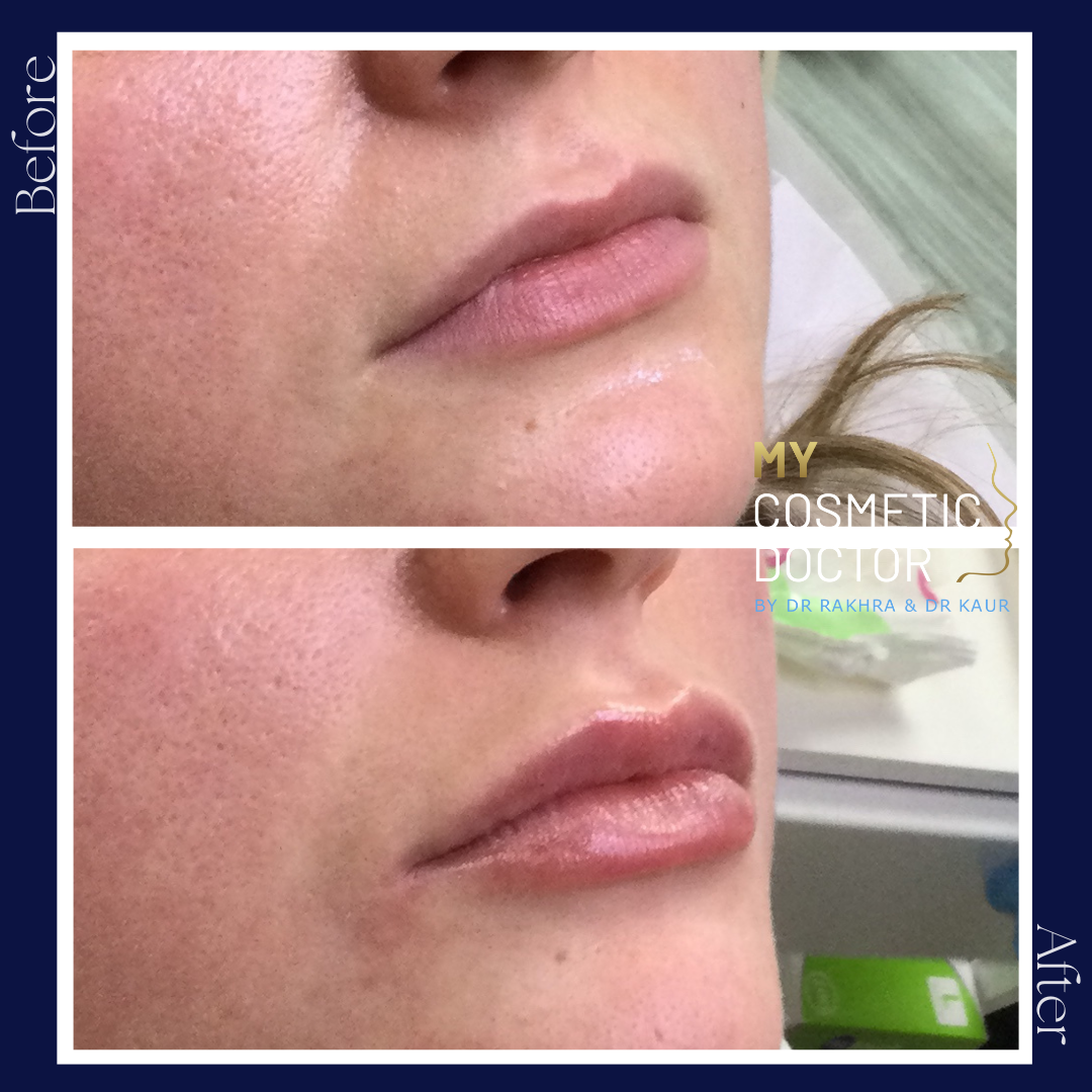 A before and after photo of a woman 's lips with my cosmetic doctor written on the bottom