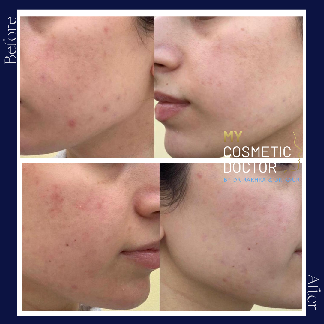 A before and after photo of a woman 's face with acne.
