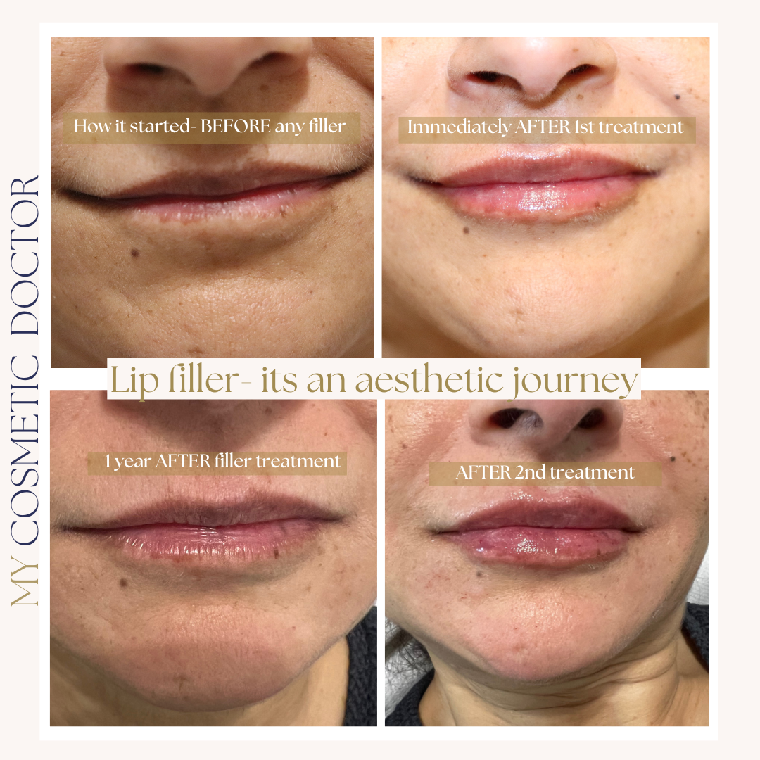 A before and after photo of a woman 's lips with the caption lip filler it 's an aesthetic journey