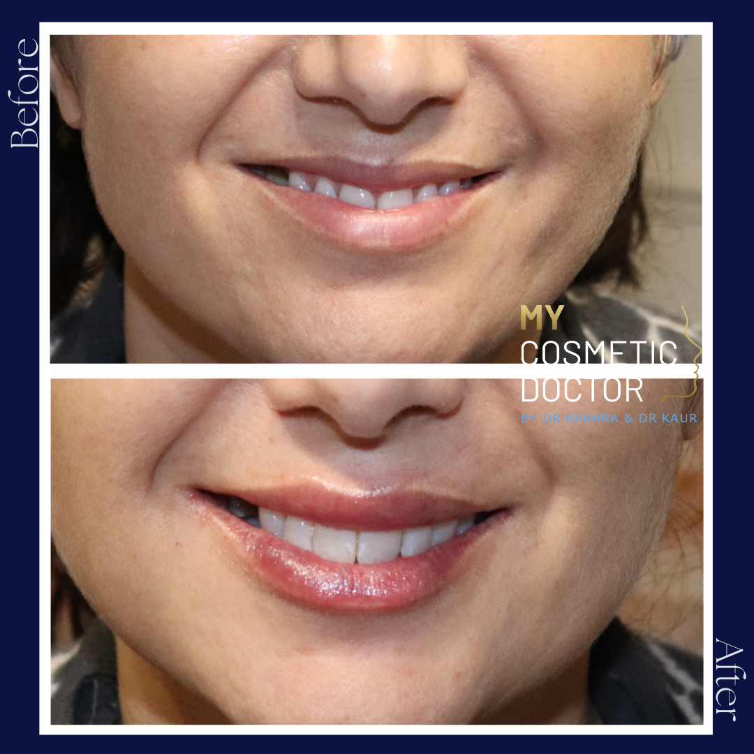 A before and after photo of a woman 's smile