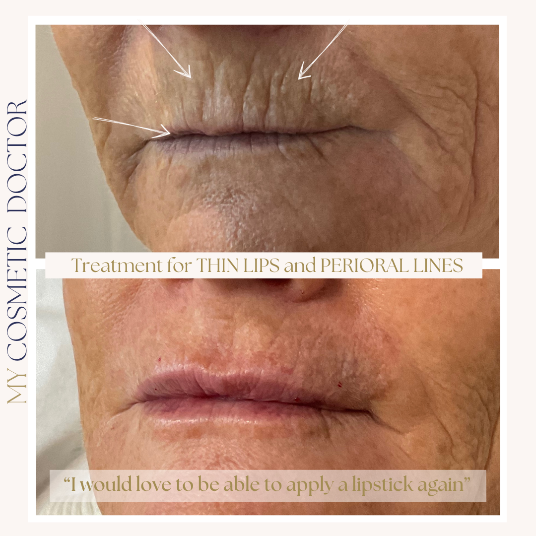 A before and after photo of a woman 's lips and perioral lines