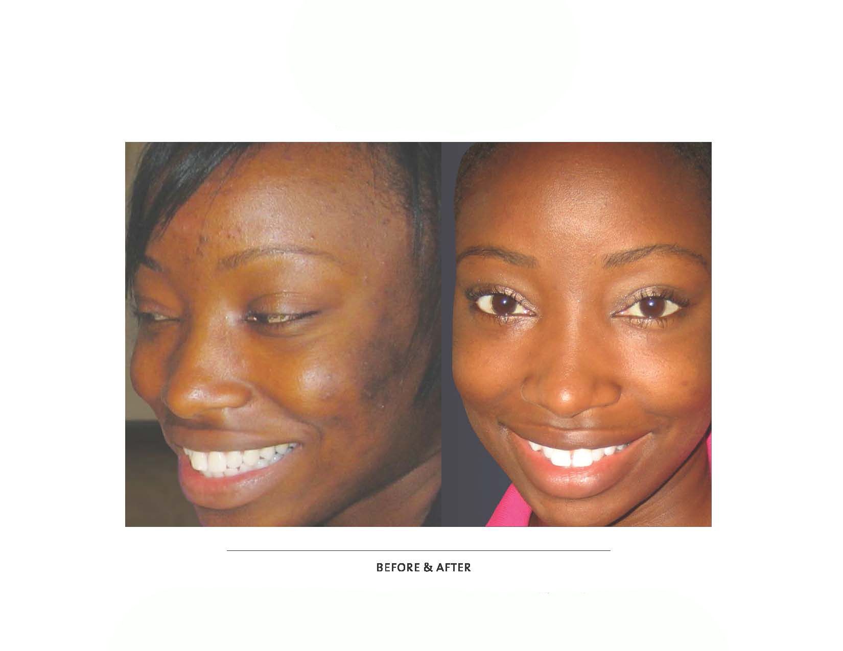 A before and after photo of a woman 's face