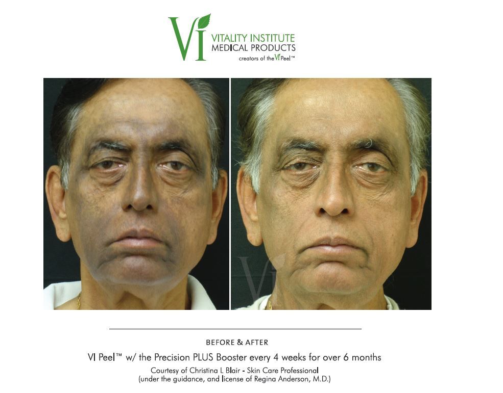 A before and after photo of a man 's face