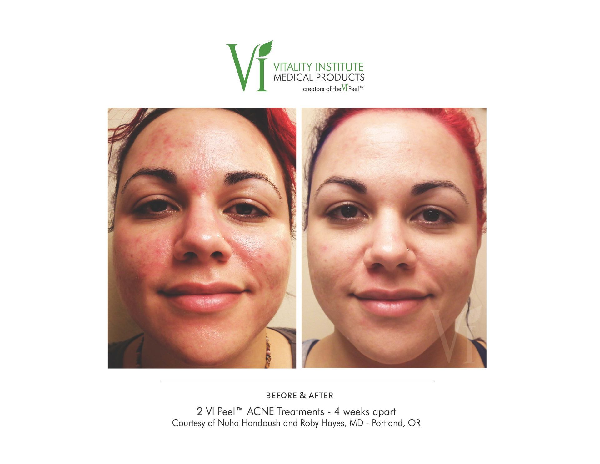 A before and after photo of a woman 's face