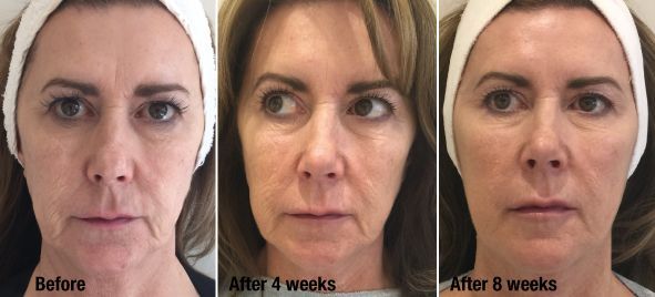 Three pictures of a woman 's face before and after a treatment.