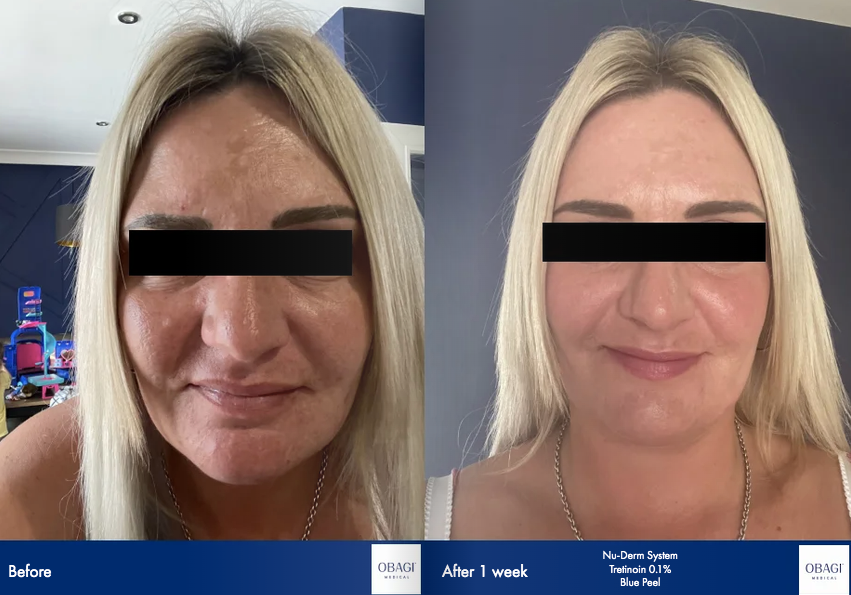 A before and after photo of a woman 's face.