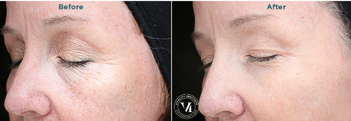 A before and after photo of a woman 's face with her eyes closed.