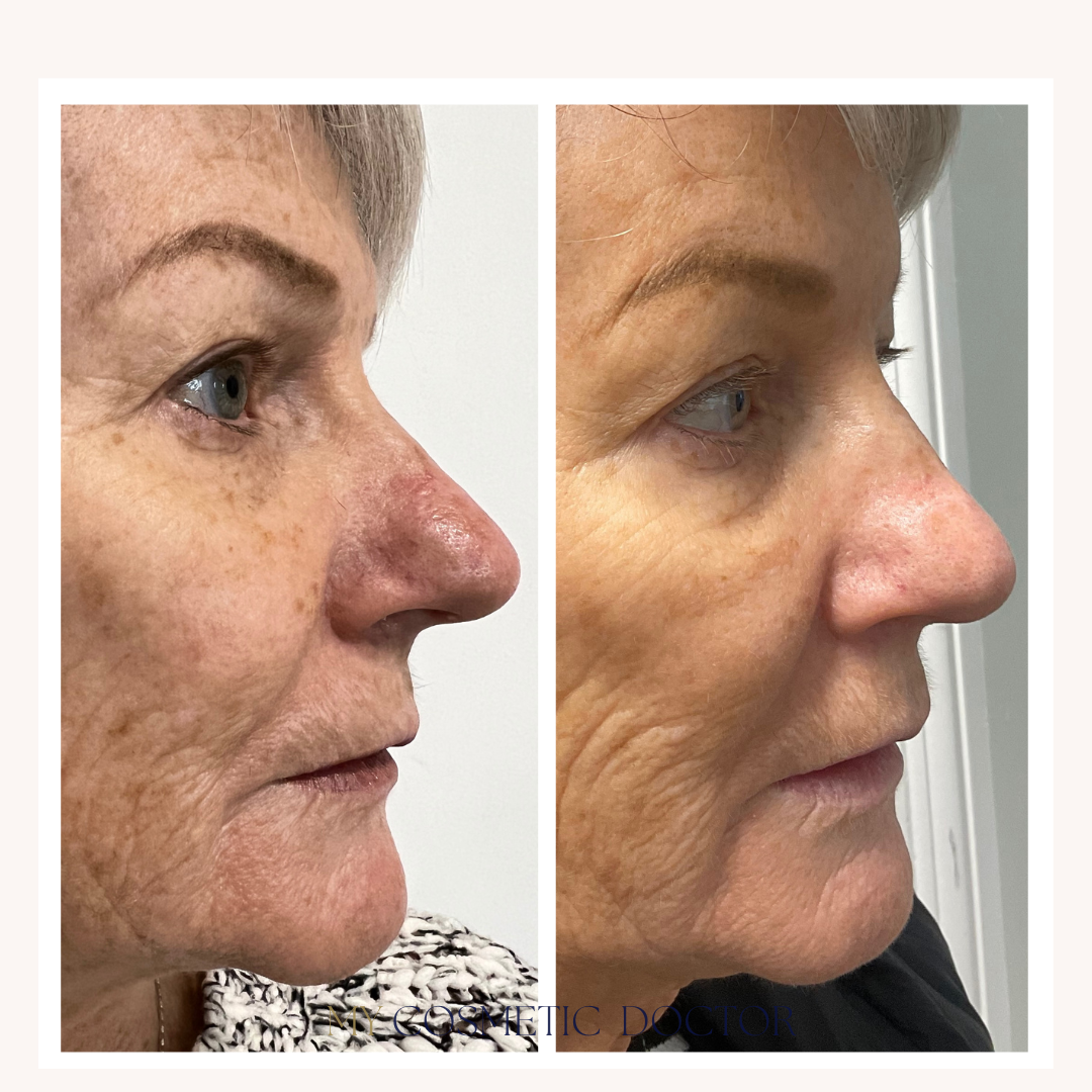 A before and after photo of a woman 's face.