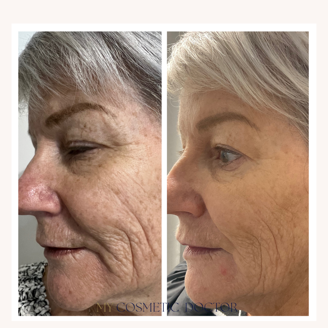 A before and after photo of an older woman 's face.