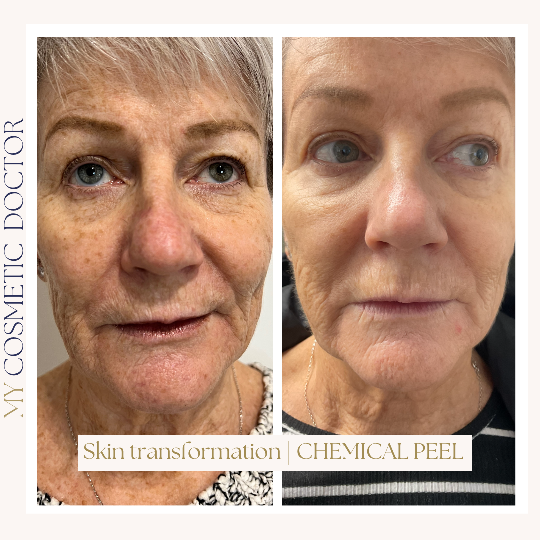 A woman 's face is shown before and after a chemical peel.