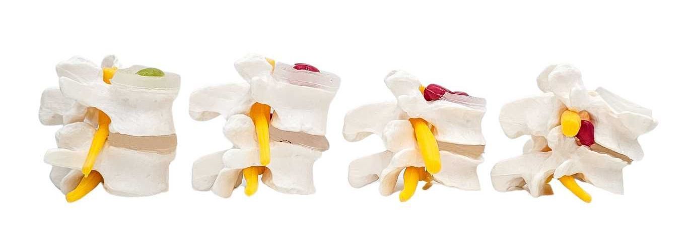The 4 stages of Disc injury The 4 stages of Disc injury