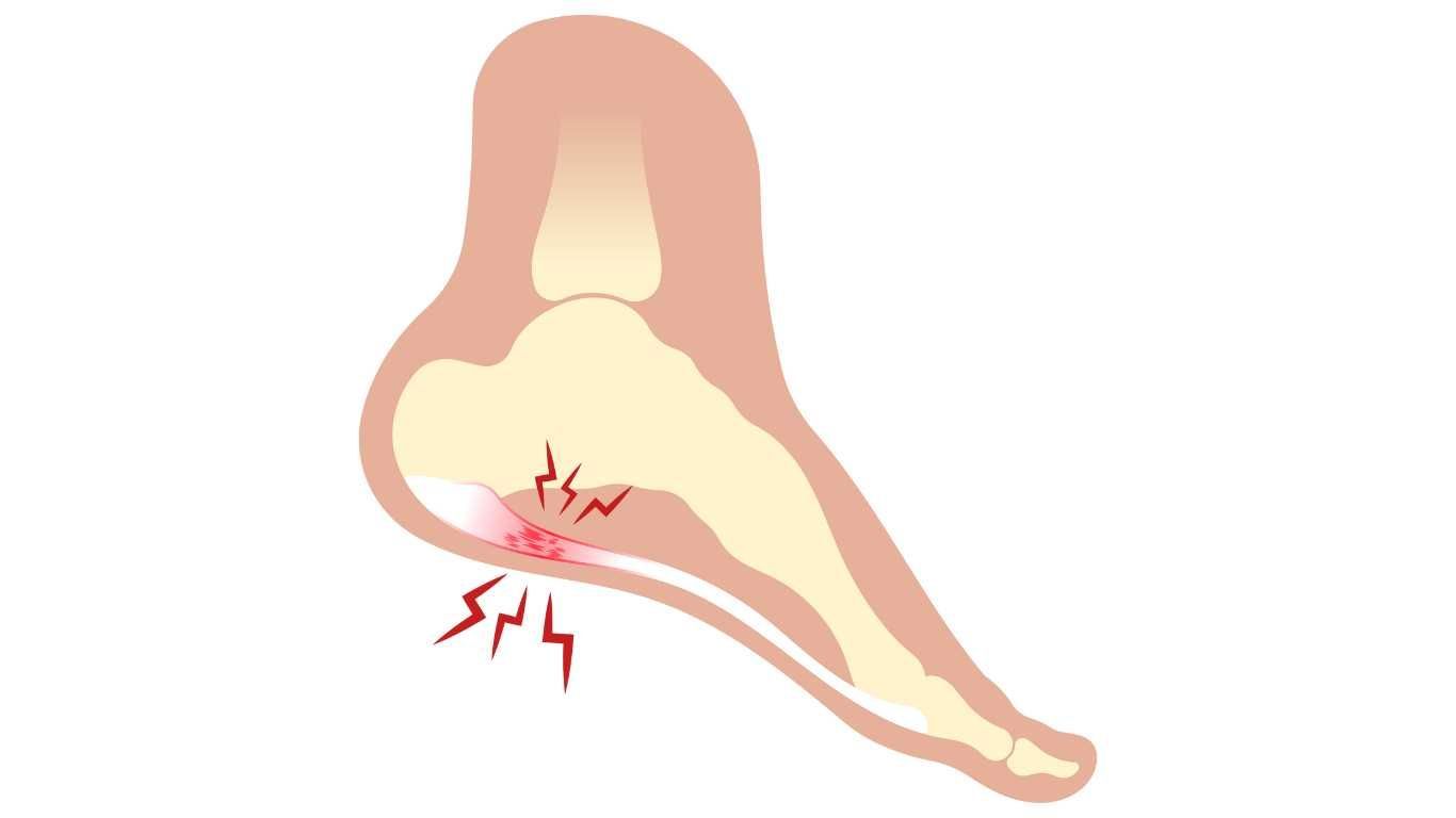 Plantar Fasciitis