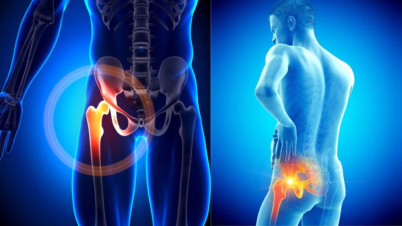 Snapping+Hip+Syndrome+Xrays