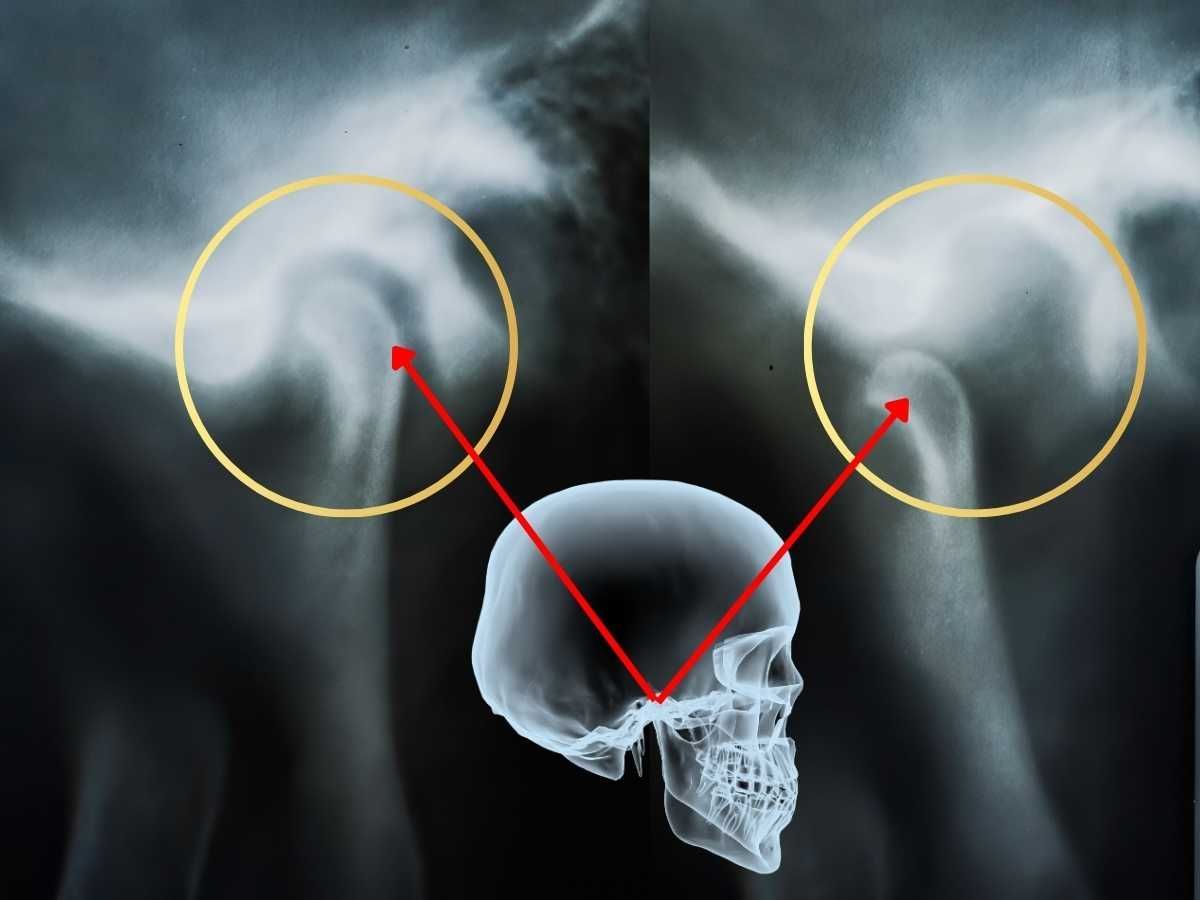 Temporomandibular Joint Disorder (TMJ) Temporomandibular Joint Disorder (TMJ)