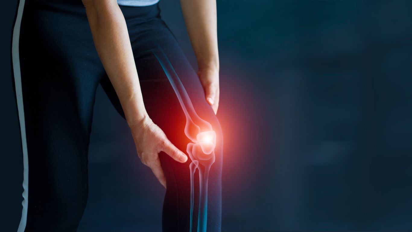 Arthritis Arthritis