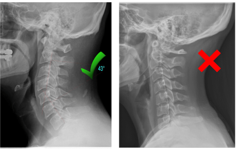 chiropractor for neck pain singapore