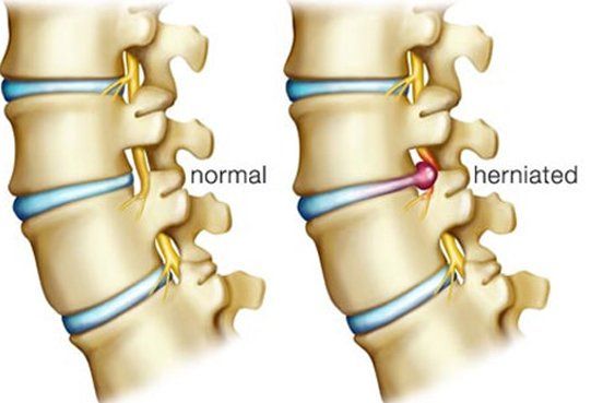 Herniated Disc Herniated Disc