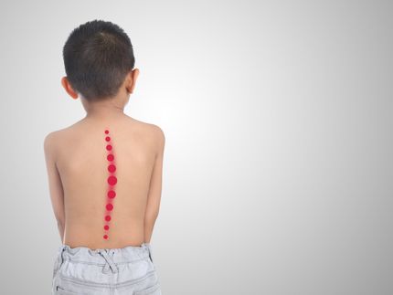 Scoliosis