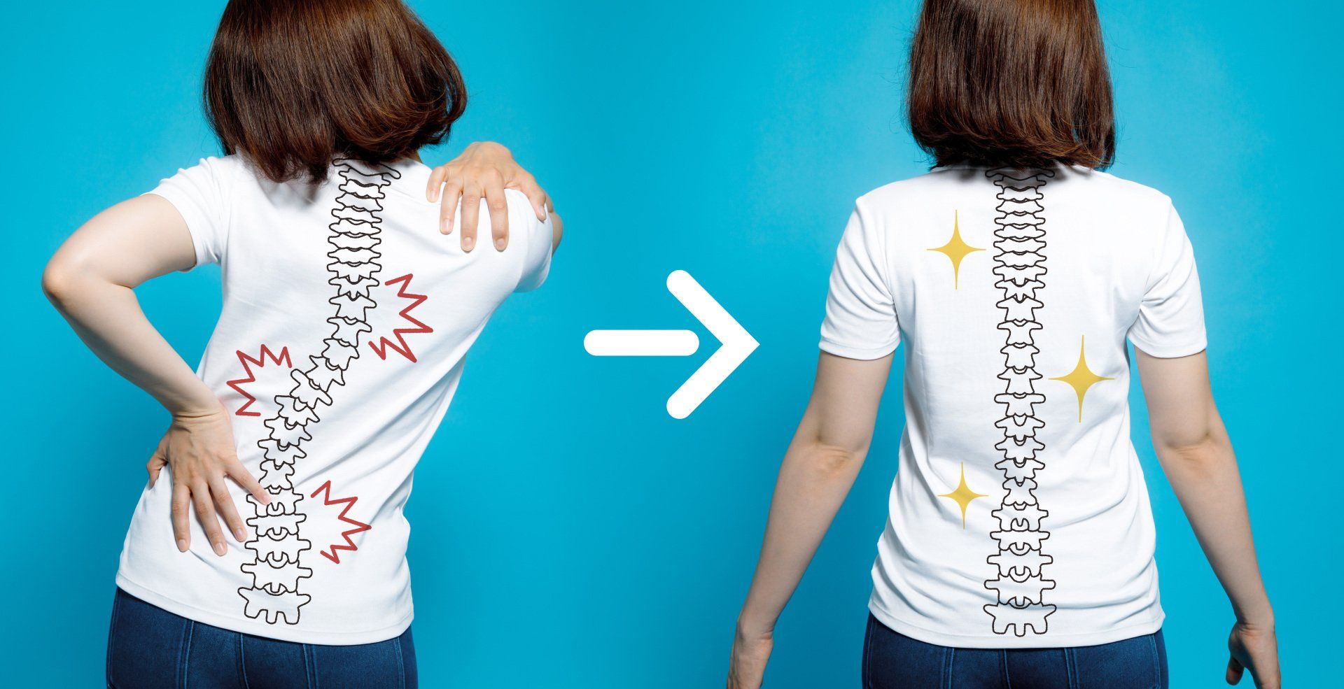 An illustration of a woman with scoliosis (before and after image)