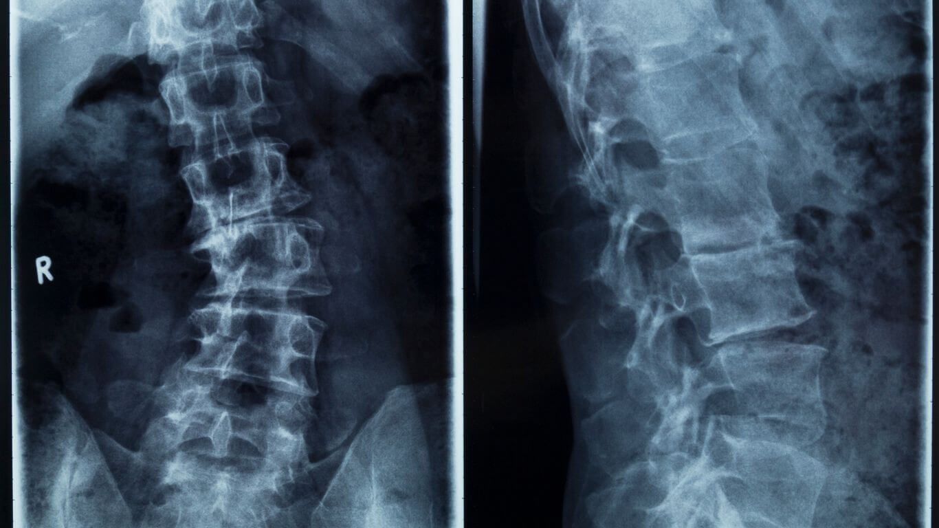 Scoliosis X-Rays
