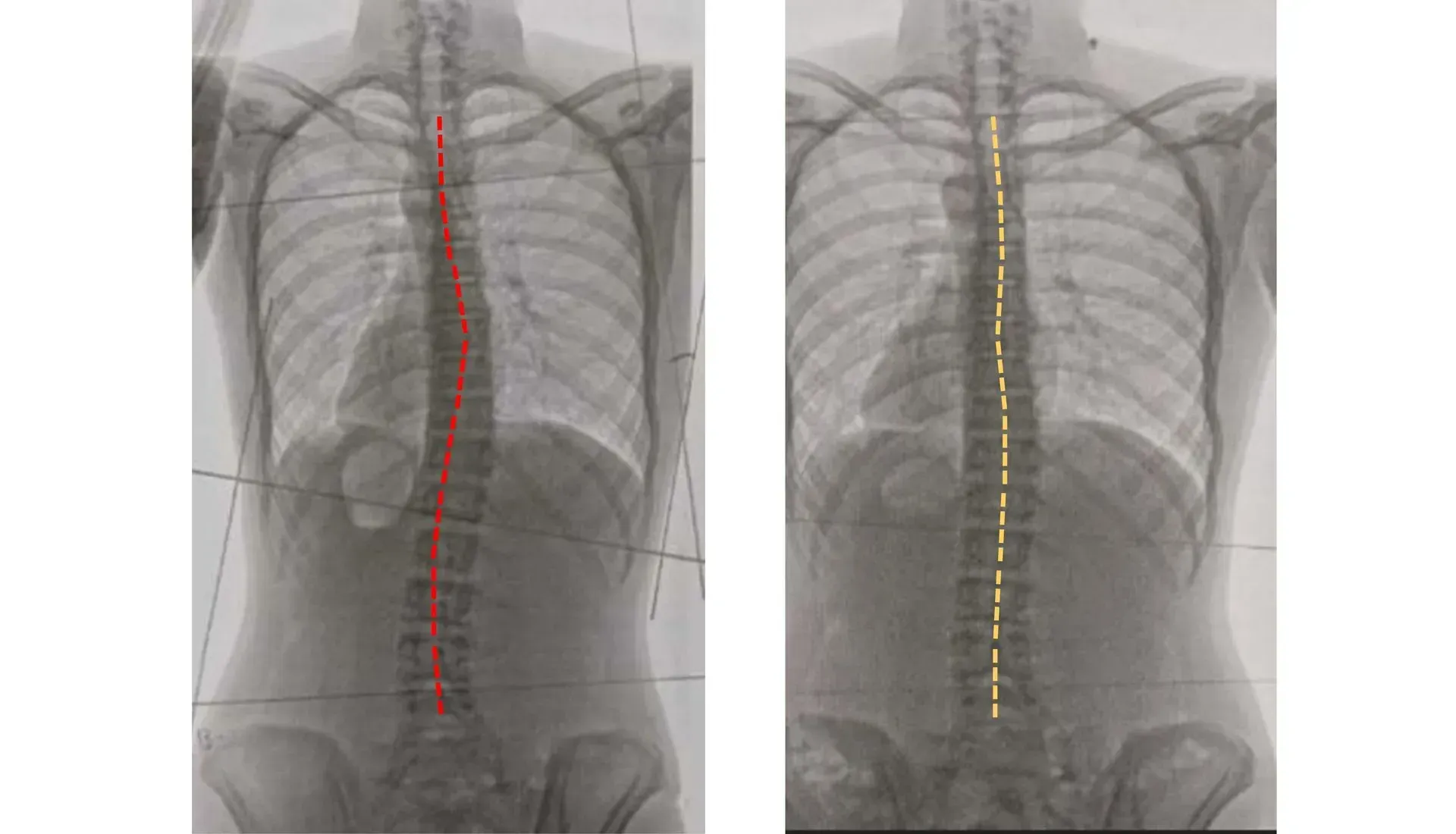 x ray of a scoliosis patient