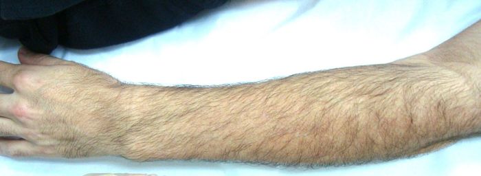 Braço masculino com crescimento natural de pelos antes do tratamento de depilação a laser.