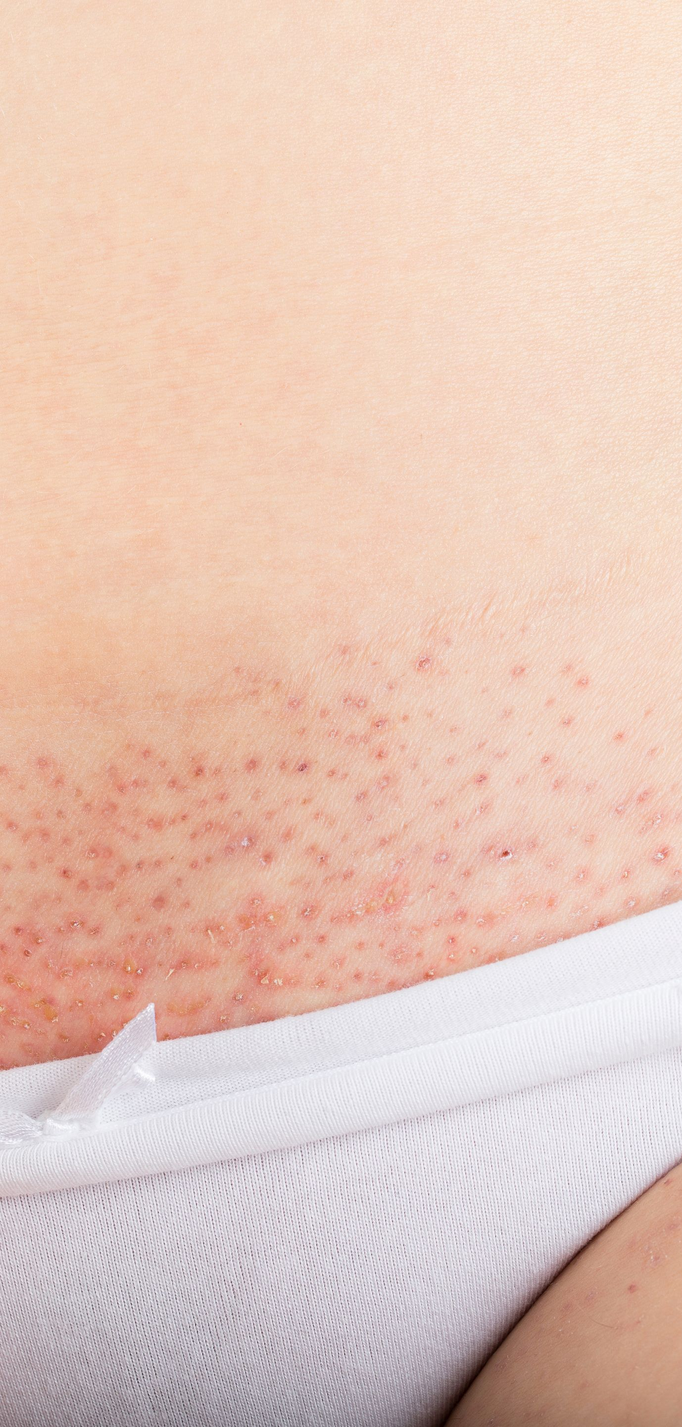 Foliculite, pelos encravados e irritação na virilha.