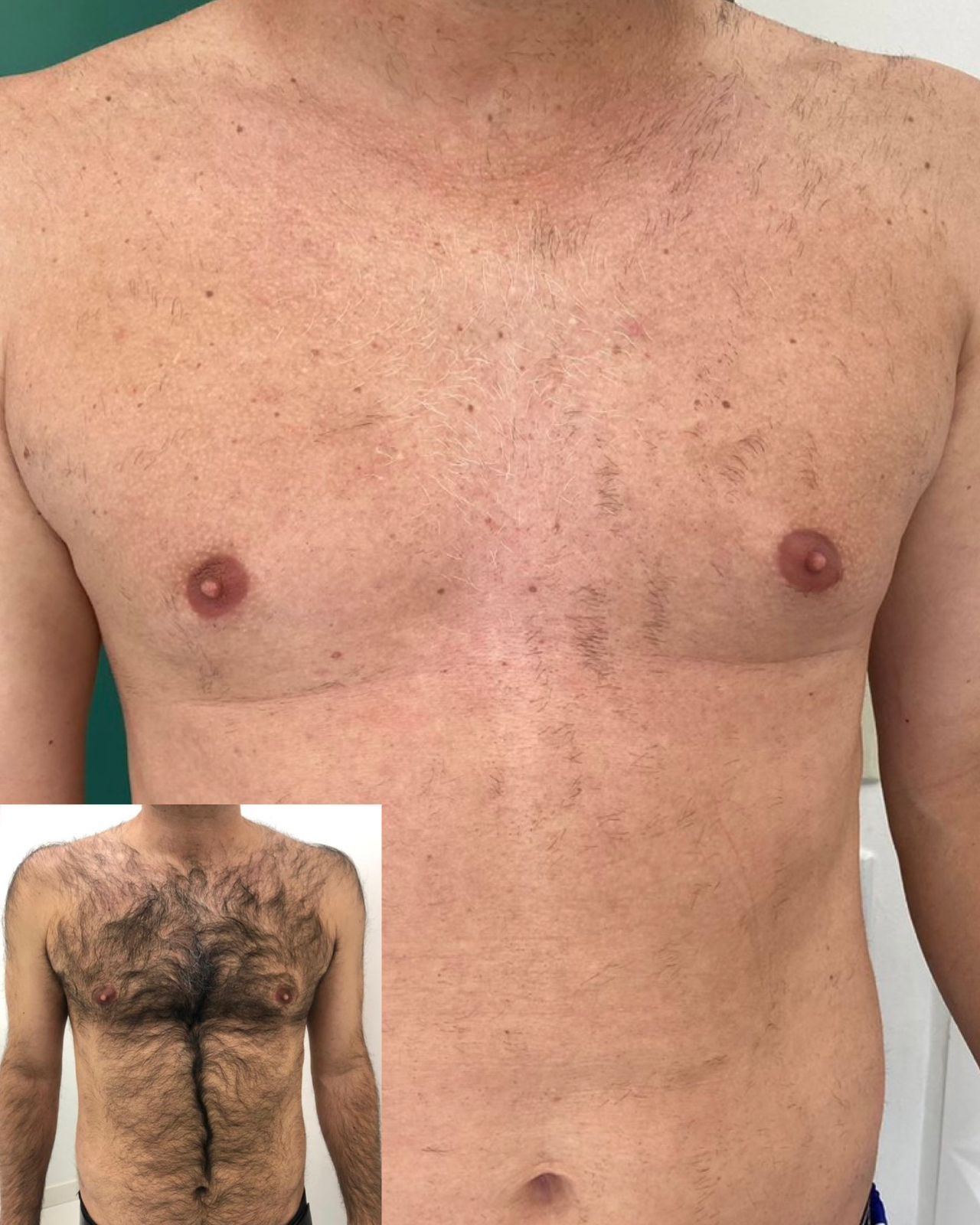 Torax e Abdome sem pelos após depilação a laser