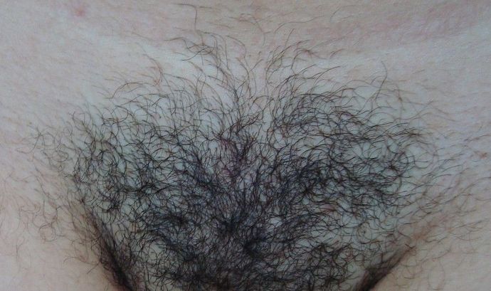 Primeira sessão de Virilha Completa Região da virilha com pelos aparentes antes de iniciar as sessões de depilação a laser.