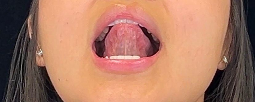 Tongue & Cheek Exercise - Myofunctional Homework